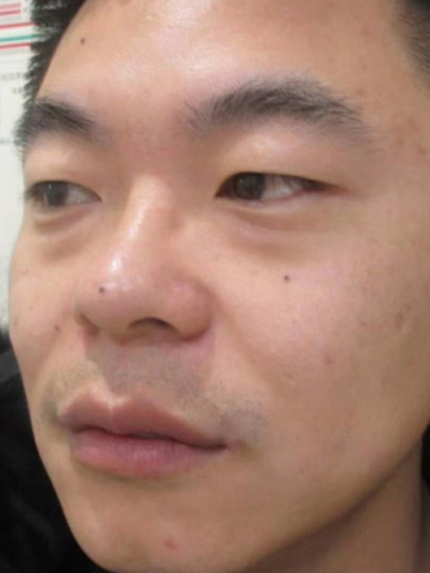 去眼袋手术