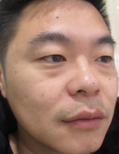 去眼袋手术