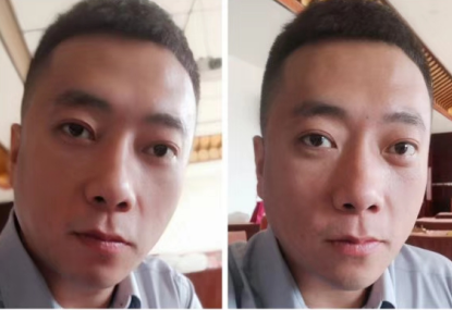 去眼袋手术