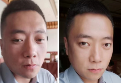 去眼袋手术