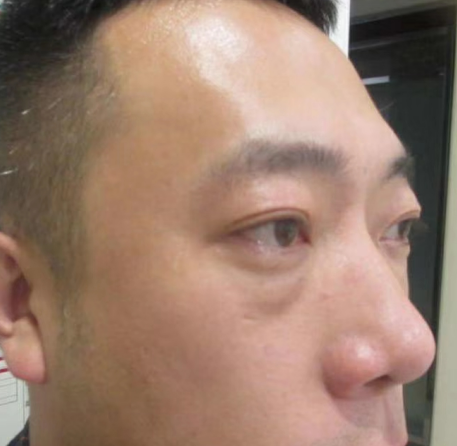 去眼袋手术