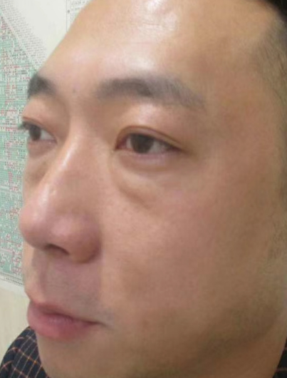 去眼袋手术