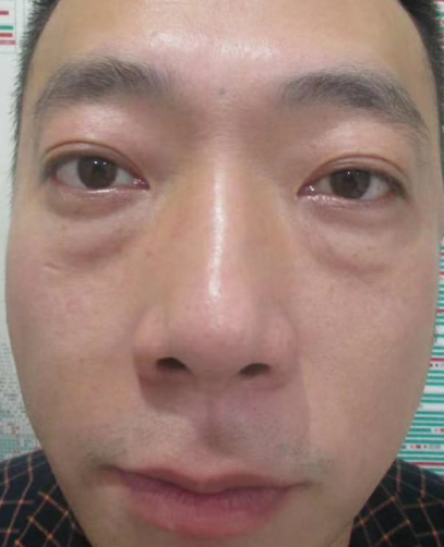 去眼袋手术