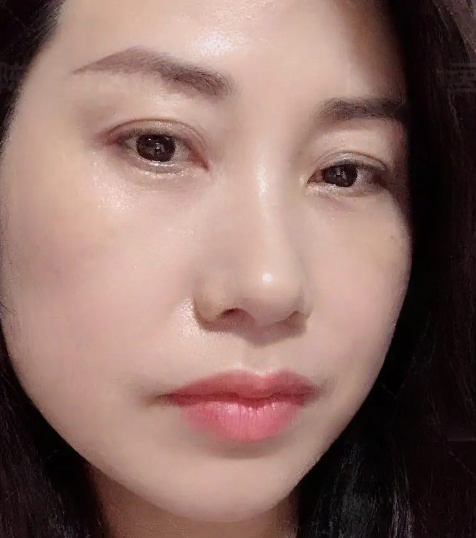 去眼袋手术