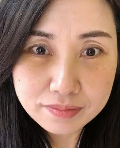 去眼袋手术