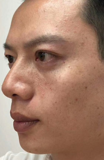 去眼袋手术