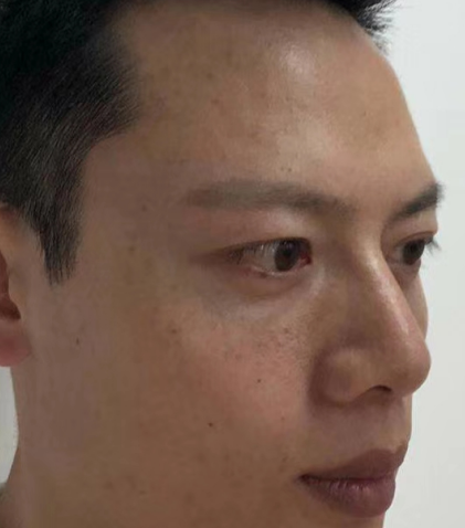 去眼袋手术