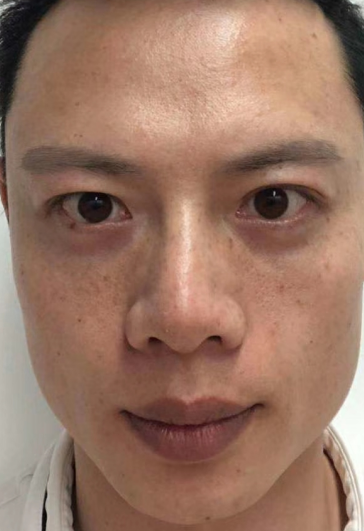 去眼袋手术