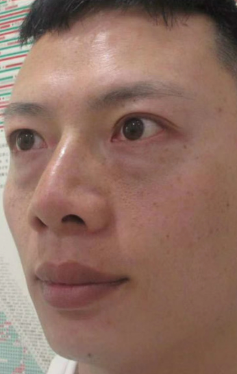 去眼袋手术