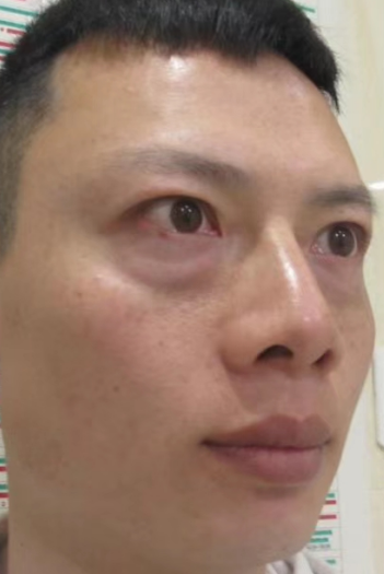 去眼袋手术