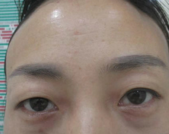 去眼袋手术