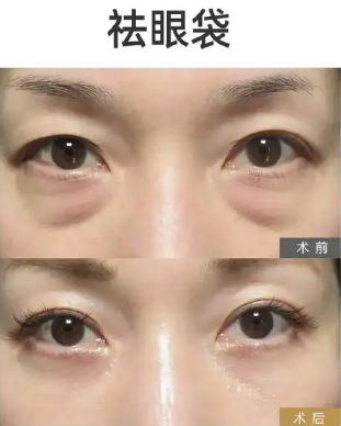 去眼袋手术