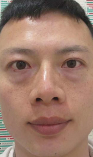 去眼袋手术