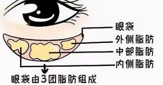 去眼袋手术