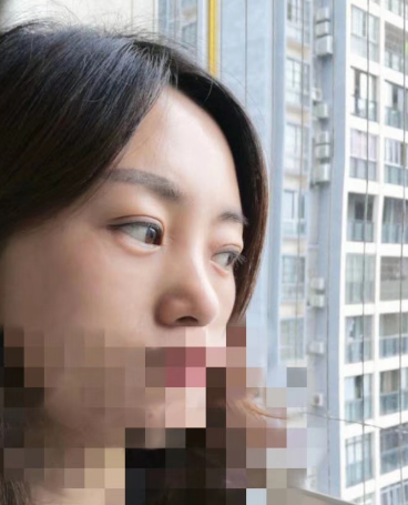 去眼袋手术