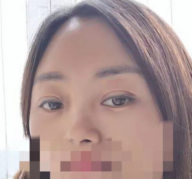 去眼袋手术