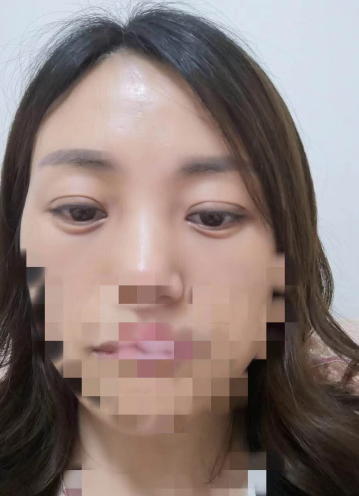 去眼袋手术