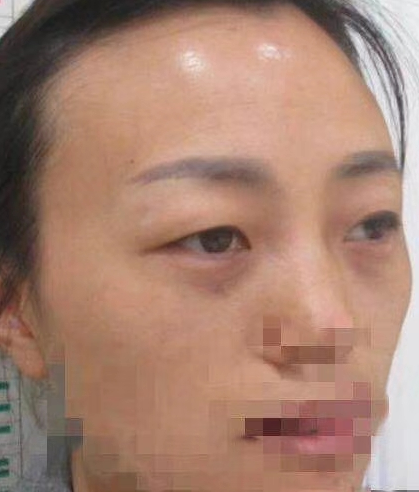 去眼袋手术
