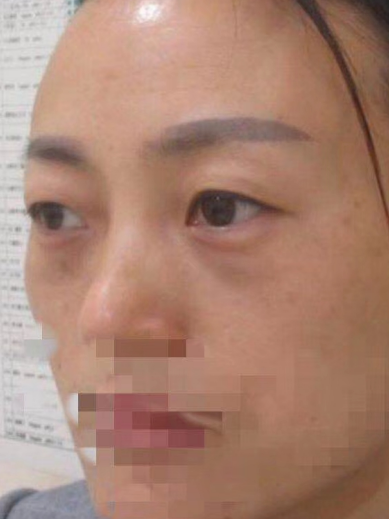 去眼袋手术