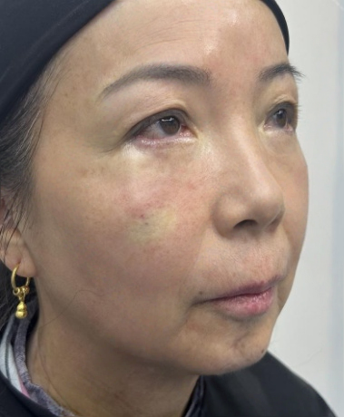 去眼袋手术