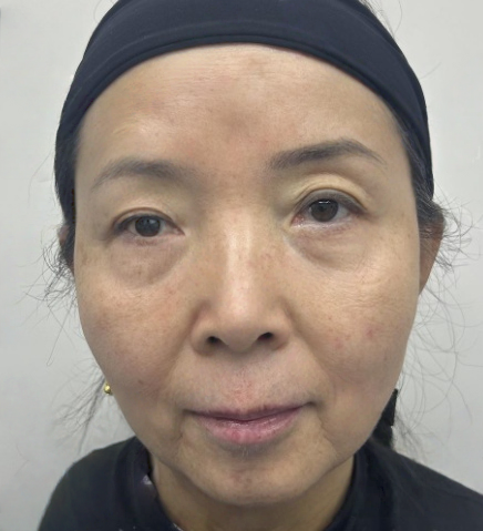 去眼袋手术