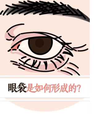 去眼袋手术