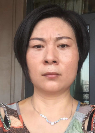 去眼袋手术