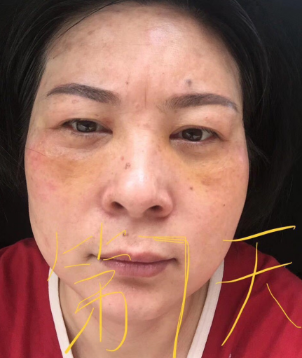 去眼袋手术