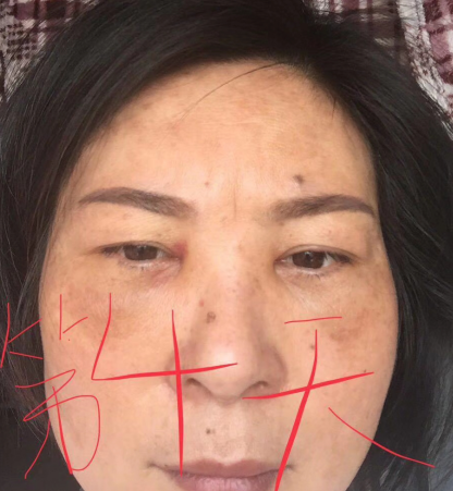 去眼袋手术