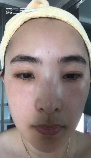去眼袋手术