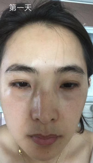 去眼袋手术