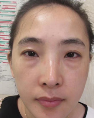 去眼袋手术