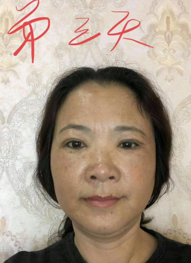 去眼袋手术