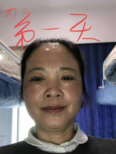 去眼袋手术