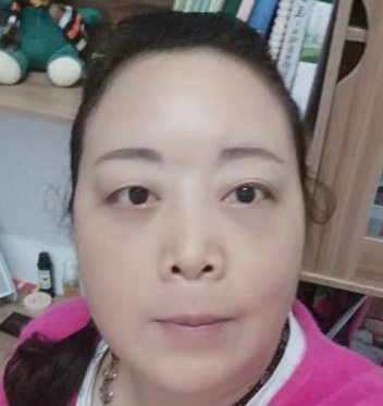 去眼袋手术