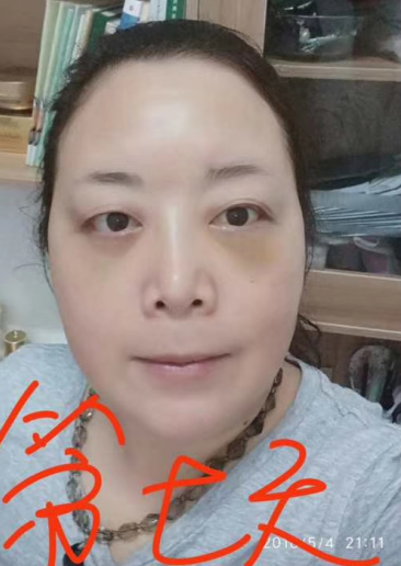 去眼袋手术