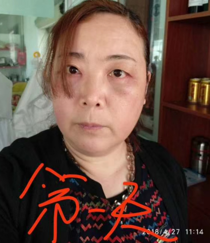 去眼袋手术