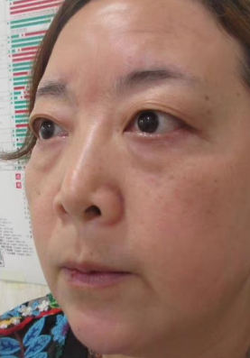 去眼袋手术