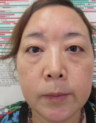 去眼袋手术