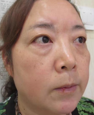 去眼袋手术