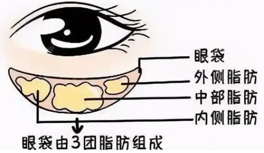 去眼袋手术