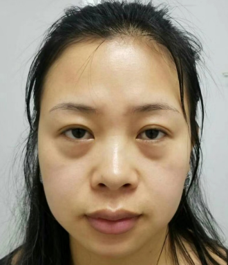 去眼袋手术