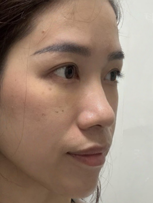 去眼袋手术