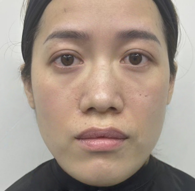 去眼袋手术