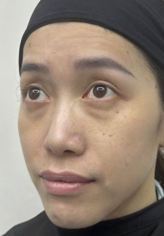 去眼袋手术