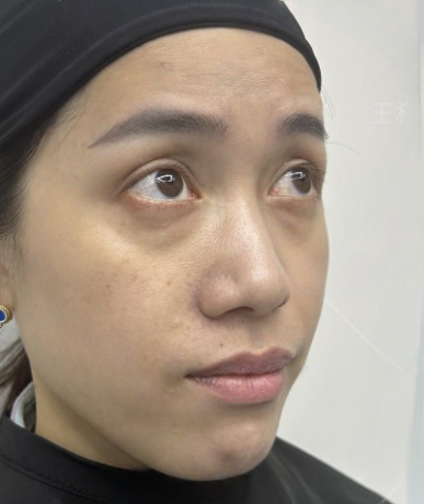 去眼袋手术