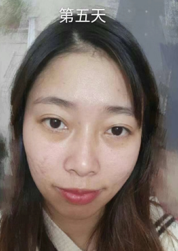 去眼袋手术