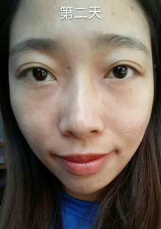 去眼袋手术