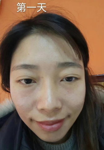 去眼袋手术