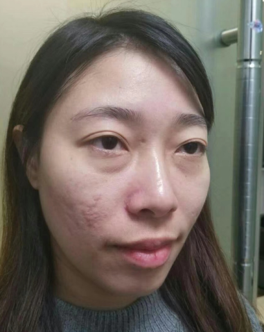 去眼袋手术